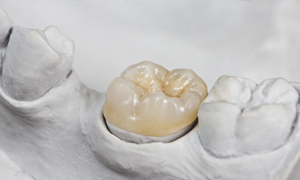 Model of a tooth with dental crown