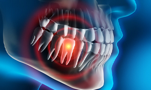 Toothache