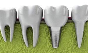 Illustration of a dental implant in the lower jaw