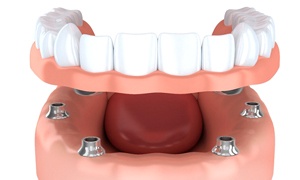 Illustration of lower denture being placed on dental implants