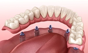 Illustration showing six dental implants and accompanying denture
