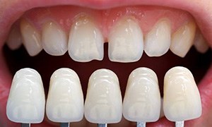 Matching veneers to teeth