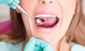 Close up of dental patient with a dental mirror in her mouth