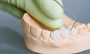 Dentist crafting a dental bridge