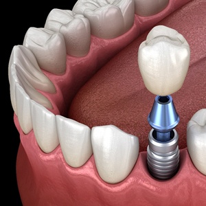 Digital model of dental implants in Metairie