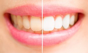 Close up of smile before and after teeth whitening