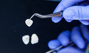 Dentist holding veneer with tweezers