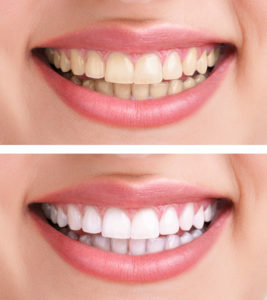 before and after smile from whitening