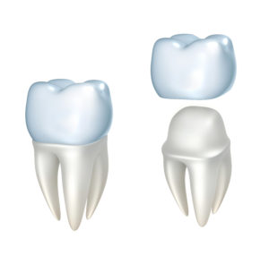 Model of a crown being placed on a back tooth