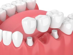 digital image dental crown placement